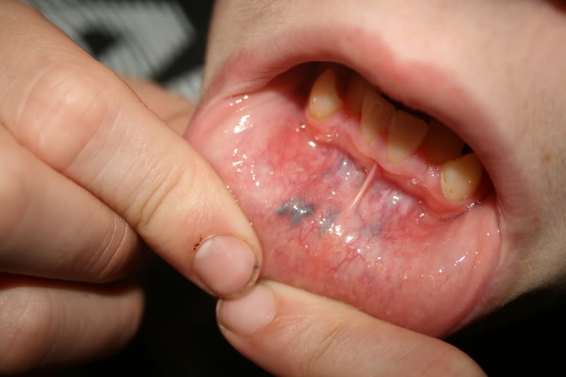 Blood Blister Inner Lip - Doctor answers on HealthTap